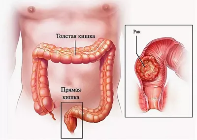 Рак прямой кишки фото