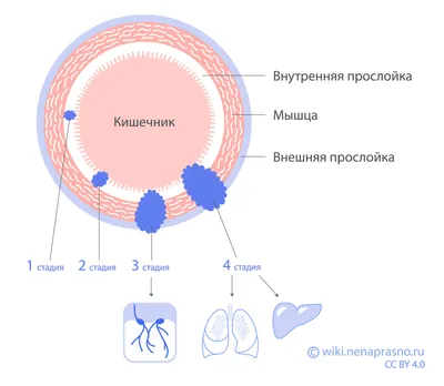 Как образуется рак толстой кишки