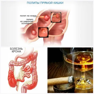 Факторы риска развития рака прямой кишки - Центр медицинской профилактики и  реабилитации Калининградской области