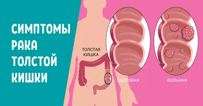 Рак прямой кишки на фоне язвенного колита (клиническое наблюдение) – тема  научной статьи по клинической медицине читайте бесплатно текст  научно-исследовательской работы в электронной библиотеке КиберЛенинка