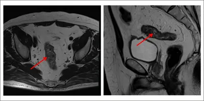 Экзофитный рак прямой кишки с региональной аденопатией | Радиография