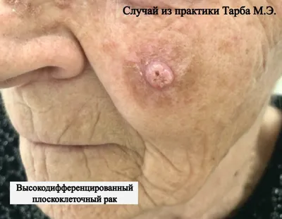 Рак полости рта: диагностика и лечение в Одессе | Медицинский дом Odrex