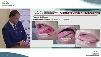 Рак десны - причины, симптомы и проявление, диагностика и лечение опухоли в  Москве