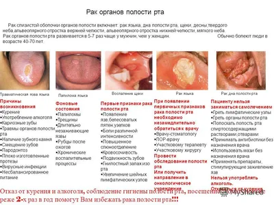 Рак полости рта - признаки, причины, симптомы, лечение и профилактика -  iDoctor.kz