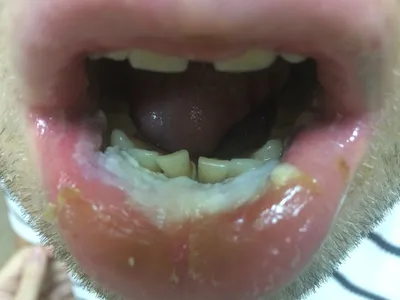 Рак губы — клиника «Добробут»