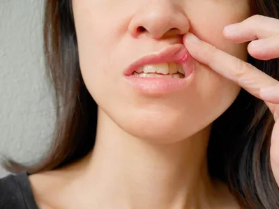 Хирургическое лечение рака губы и слизистой оболочки полости рта – тема  научной статьи по клинической медицине читайте бесплатно текст  научно-исследовательской работы в электронной библиотеке КиберЛенинка