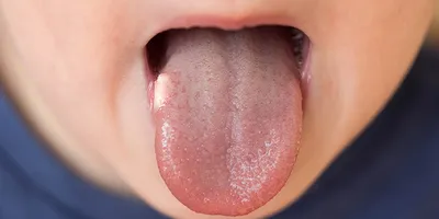 Онкоскрининг заболеваний слизистой оболочки рта, языка и губ в практике  врача-стоматолога - DENTALMAGAZINE.RU