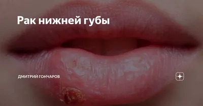 Рак губы: диагностика и лечение плоскоклеточной опухоли в Москве