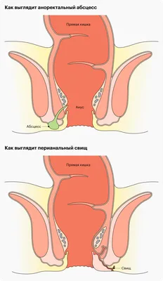 Анальные трещины и геморрой: симптомы, диагностика, отличия, что это и как  лечить