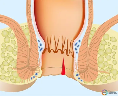 Свищи прямой кишки - лечение и удаление анальных свищей