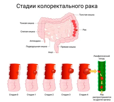 Рак прямой кишки - статьи о раке - Medical Pharm Group