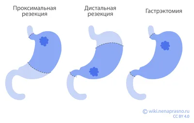 Рак желудка - как жить после удаления рака желудка. Замещение утраченного  желудка - YouTube