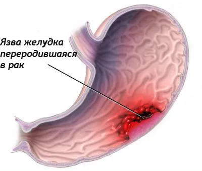 Рак желудка у молодых людей — новая форма заболевания | MadMed Media | Дзен