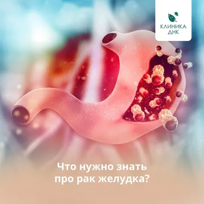 Что нужно знать про рак желудка, который в России входит в ТОП 5 самых  распространенных видов рака?