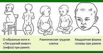 Ребра. Рахит? — 15 ответов | форум Babyblog