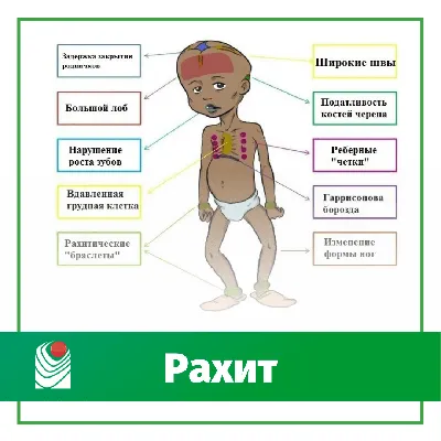 Рахит Вообще, клинические проявления рахита могут быть и при других  заболеваниях, так называемых рахито-подобных.. | ВКонтакте