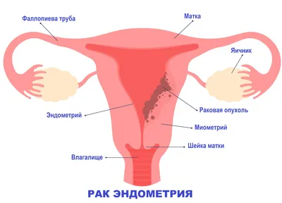 Рисование, Чтобы Показать Различные Показатели, Которые Есть Раковая Опухоль  В Груди Фотография, картинки, изображения и сток-фотография без роялти.  Image 14104644