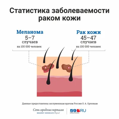 Меланома - рак кожи