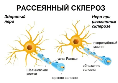 Рассеянный склероз: причины, симптомы, профилактика, лечение