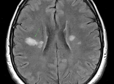 Рассеянный склероз на МРТ: как выглядит, признаки на снимке МРТ