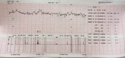 Расшифровка КТГ плода - Вопрос гинекологу - 03 Онлайн