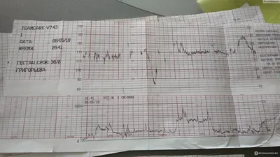 Кардиотокография (КТГ) - «КТГ как способ убедить акушерку, что схватки есть  и ты рожаешь. А вообще процедура нужная и совершенно не напряжная для  беременной. Главное себя не накручивать. » | отзывы