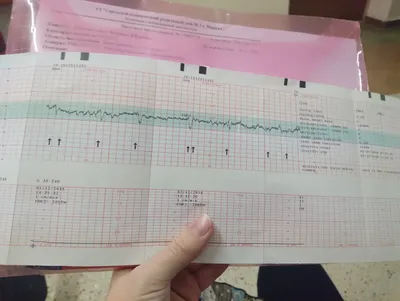 Причины плохого ктг и корректность лечения | Консультация гинеколога в  Минске на DOKTORA.BY - ВРАЧИ БЕЛАРУСИ