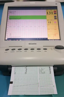 Кардиотокография (КТГ) - «Делала много раз. КТГ при беременности расшифровка.  Зачем нужно, опасно ли, как подготовиться, что делать если не получается,  что делать если результат КТГ плохой» | отзывы