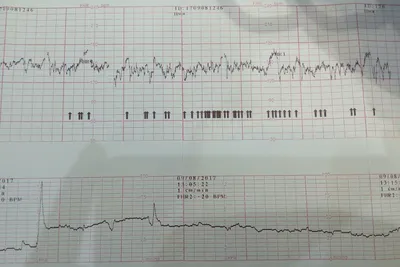 КТГ при беременности: что это и для чего проводится | Клиника 9 в Жуковском  и Раменском