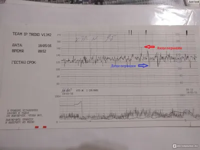 Кардиотокография (КТГ) - «Делала много раз. КТГ при беременности расшифровка.  Зачем нужно, опасно ли, как подготовиться, что делать если не получается,  что делать если результат КТГ плохой» | отзывы
