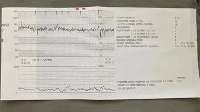 Расшифровка КТГ — 4 ответов | форум Babyblog