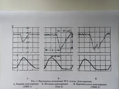 Расшифровка КТГ — 1 ответов | форум Babyblog