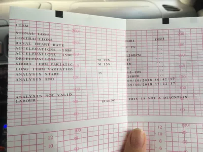 Статьи - Предотвращение возможности неверной расшифровки кардиотокограммы ( КТГ): Обзор последнего исследования анализа кривых КТГ по критериям  Доуса-Редмана - Oxford Medical