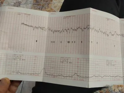 Кардиотокография (КТГ) - «Делала много раз. КТГ при беременности расшифровка.  Зачем нужно, опасно ли, как подготовиться, что делать если не получается,  что делать если результат КТГ плохой» | отзывы