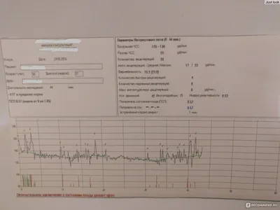 Кардиотокография (КТГ) - «Делала много раз. КТГ при беременности расшифровка.  Зачем нужно, опасно ли, как подготовиться, что делать если не получается,  что делать если результат КТГ плохой» | отзывы
