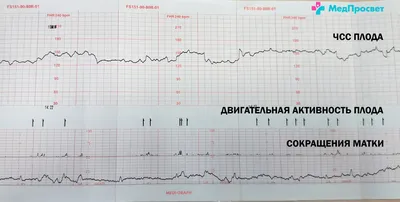КТГ при беременности (кардиотокография плода) в СПб | Клиника МедПросвет