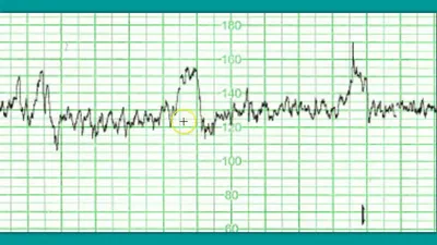 Образцы КТГ