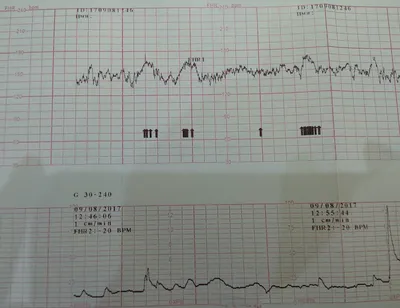 Интерпретация нормальной кардиотокограммы - YouTube