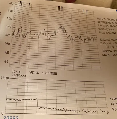 КТГ(кардиотокография) плода сегодня этим исследованием никого не удивишь😱  Давайте разберемся,что за метод исследования❓Для чего он нужен❓И … |  Instagram
