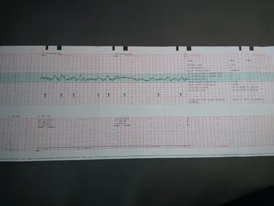 Причины плохого ктг и корректность лечения | Консультация гинеколога в  Минске на DOKTORA.BY - ВРАЧИ БЕЛАРУСИ