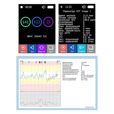 КТГ плода | Медицинский Центр Доктора Аладинской В.В