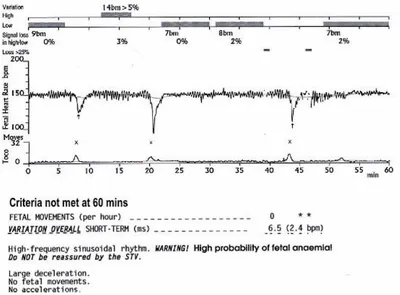 Статьи - Предотвращение возможности неверной расшифровки кардиотокограммы ( КТГ): Обзор последнего исследования анализа кривых КТГ по критериям  Доуса-Редмана - Oxford Medical