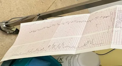 Кардиотокография плода (КТГ) при беременности с расшифровкой цена в Москве  в АльтраВита