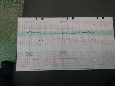 Причины плохого ктг и корректность лечения | Консультация гинеколога в  Минске на DOKTORA.BY - ВРАЧИ БЕЛАРУСИ
