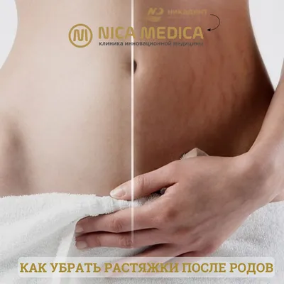 Как убрать растяжки после родов — отвечают врачи NICA MEDICA