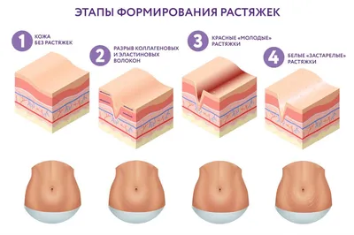 Как избавиться от растяжек на груди?