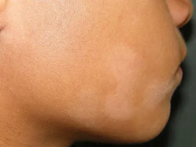 ПигментныеПятна и Отрубевидный лишай - темные пятна с локализуются на лице.  Косметологу важно уметь различать эти состояния, так как… | Instagram