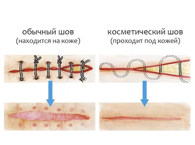 Эпизиотомия при родах - «Эпизиотомия - помощь для роженицы. Не так страшен  черт, как его рисуют!» | отзывы