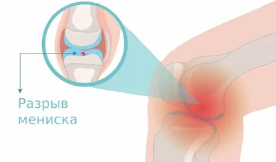 Симптомы разрыва мениска коленного сустава | Главная