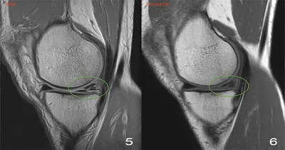 Разрыв мениска (коленного сустава): симптомы, лечение